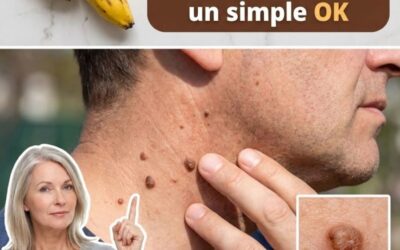 Dile Adiós a las Verrugas